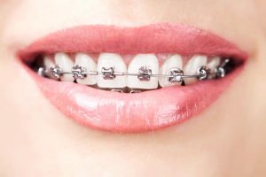 Patient with braces 