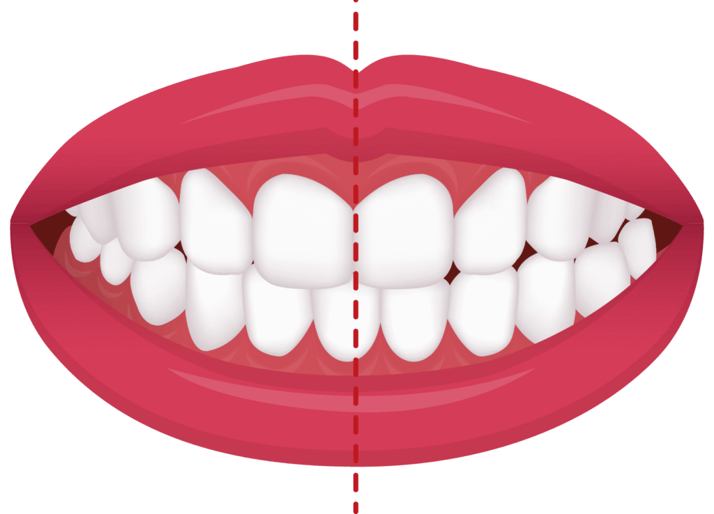 crossbite