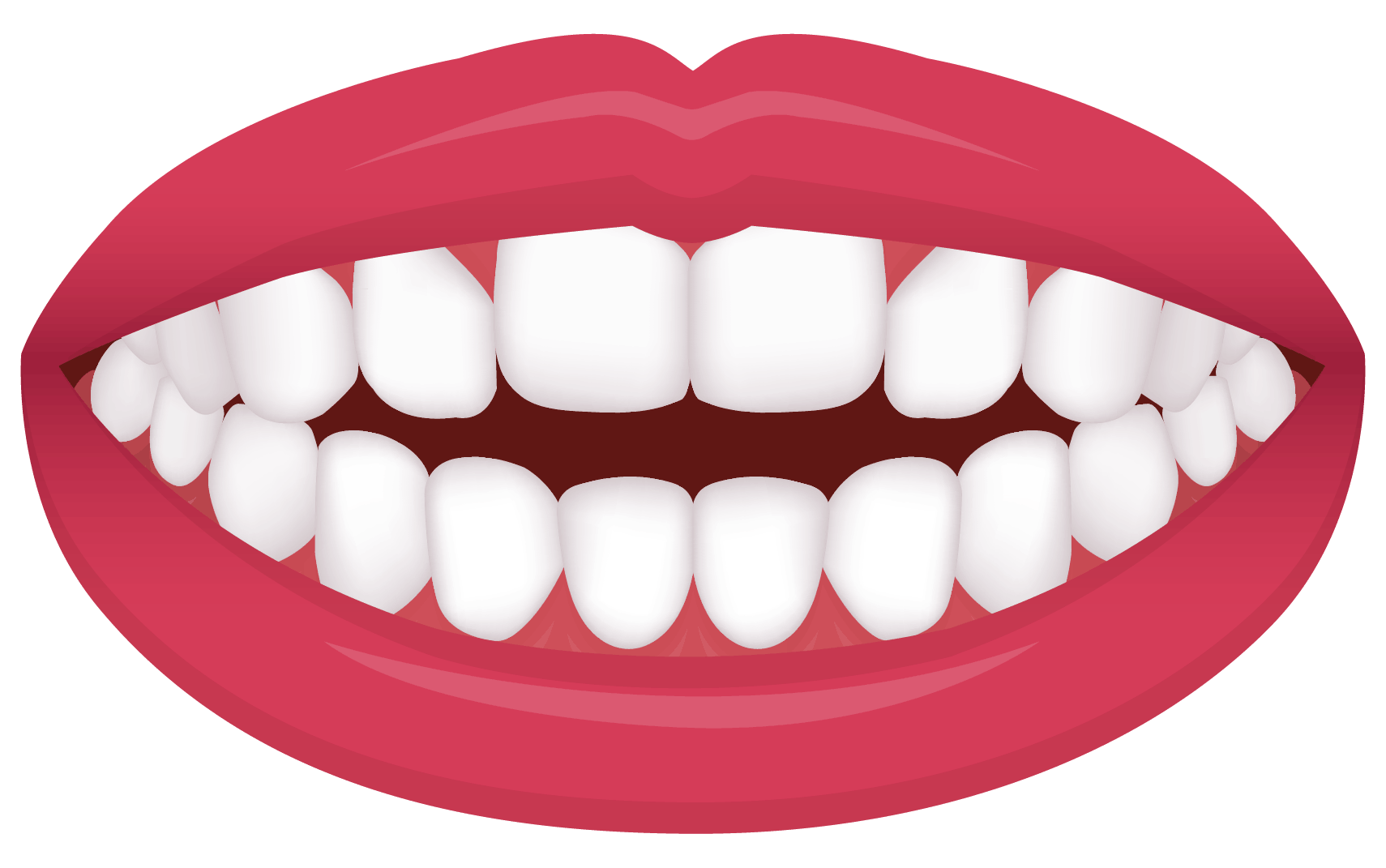 open bite