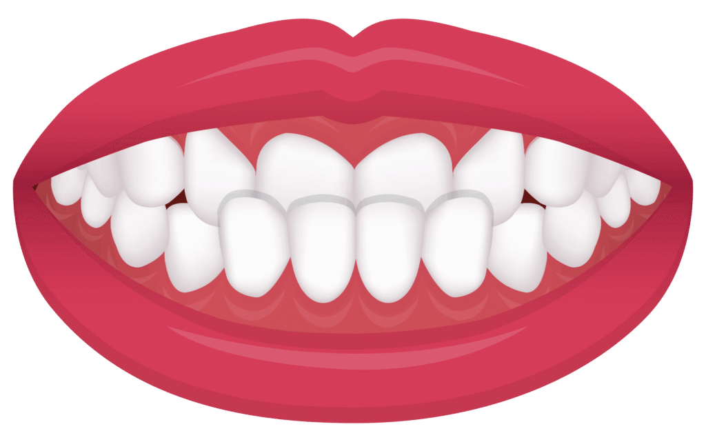 underbite