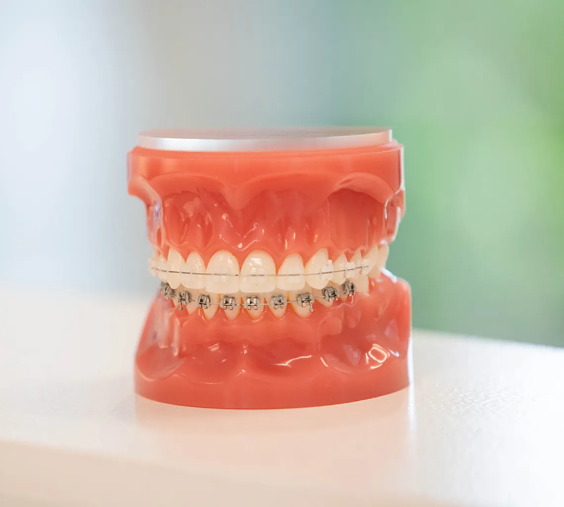 clear braces