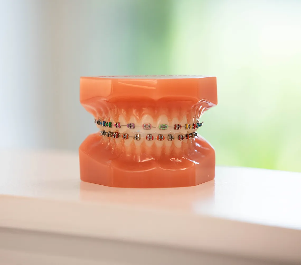 metal braces