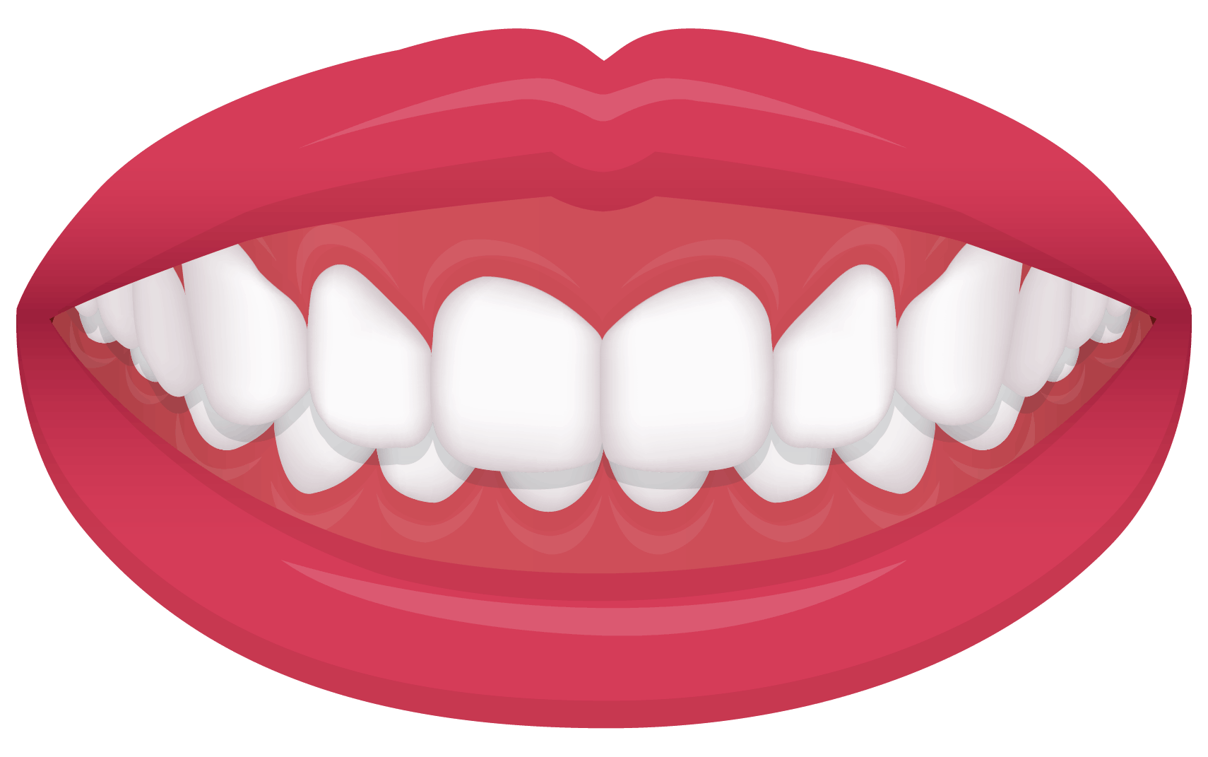 overbite