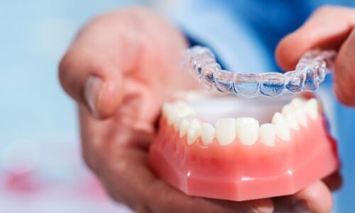 Invisible and removable aligners for teeth alignment