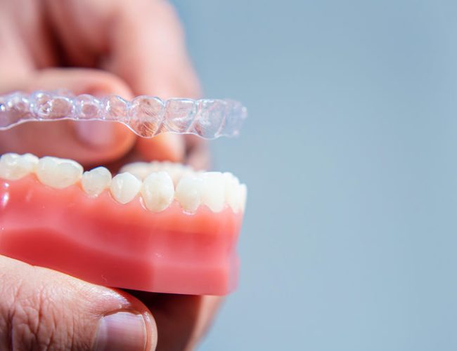 Close-up. The doctor puts transparent aligners on the teeth of the artificial jaw