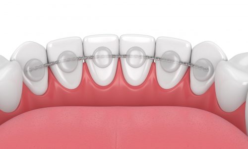 3d render of dental bonded retainer on lower jaw over white background