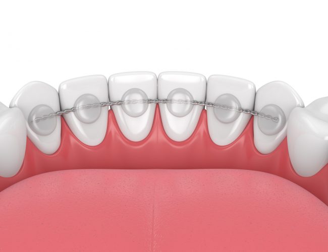 3d render of dental bonded retainer on lower jaw over white background