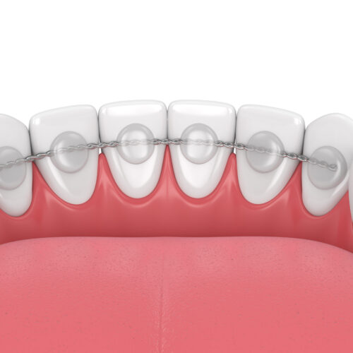 3d render of dental bonded retainer on lower jaw over white background