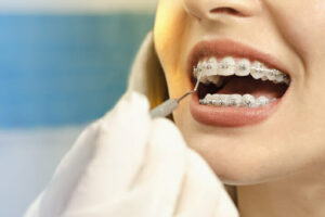 Closeup dental braces checkup , perfect white teeth with dental braces woman in half smile