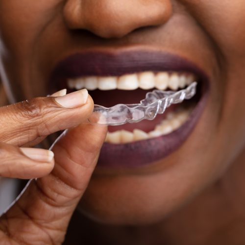 Close-up Of A Woman's Hand Putting Transparent Aligner In Teeth