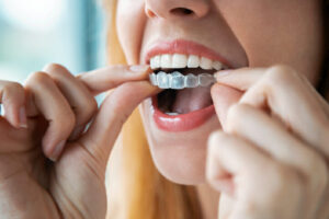 Close-up of woman wearing orthodontic silicone trainer. Invisible braces aligner.