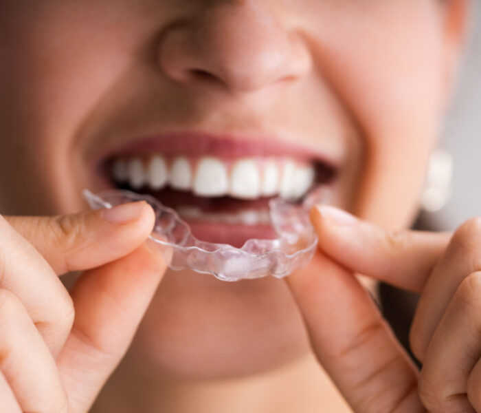 Clear Aligner Dental Night Guard For Teeth