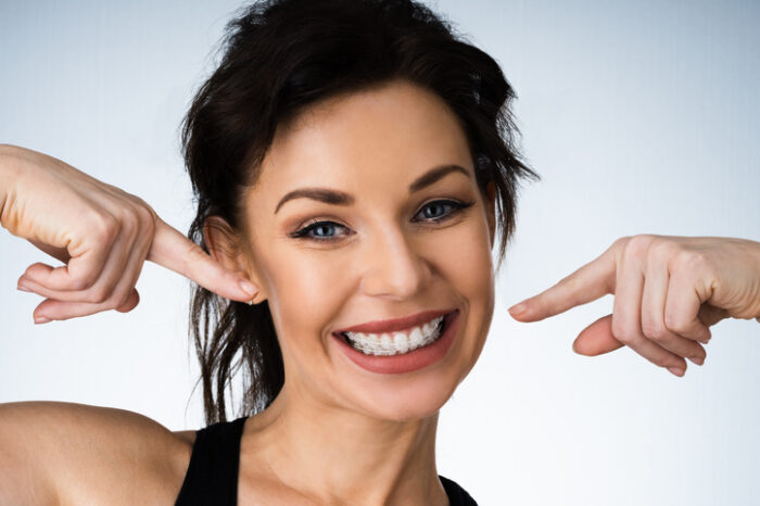 Female Mouth With Metal White Dental Braces Or Brackets