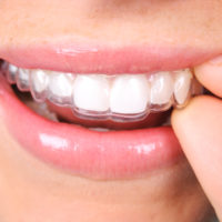 Retainer Close up of a person putting in a retainer.PLEASE CLICK ON THE IMAGE BELOW TO SEE MY MEDICAL TECHNOLOGY LIGHTBOX: