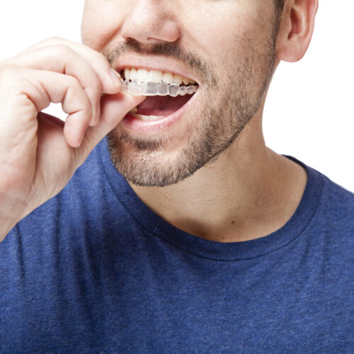 Young man wearing clear braces.