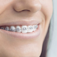 Woman with brackets Young woman with brackets