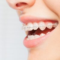 Woman’s smile with clear dental braces on teeth Side view picture of woman's smile with clear dental braces on teeth against blanked background