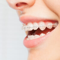 Side view picture of woman's smile with clear dental braces on teeth against blanked background